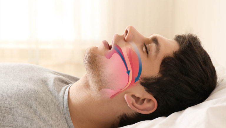 Sleep Apnea Graphic Smile Designs Of The Shenandoah Valley